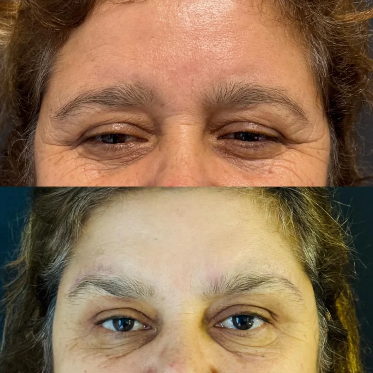 Op. Dr. Zekiye Kabaş - Göz Kapağı Estetiği-4