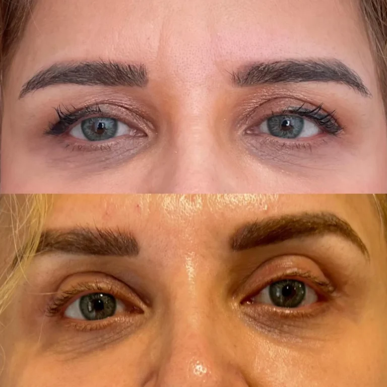 Op. Dr. Zekiye Kabaş - Göz Kapağı Estetiği